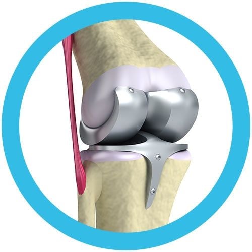Knee Replacement real image