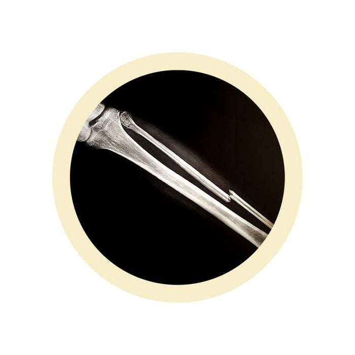 Broken Bone real image