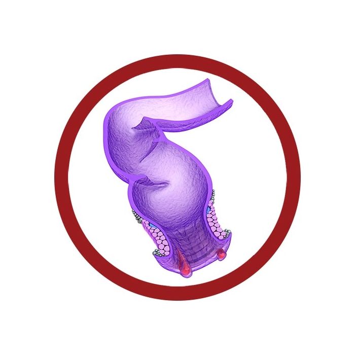 Hemorrhoid real image