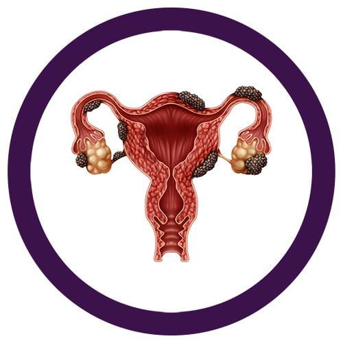 Endometriosis real image