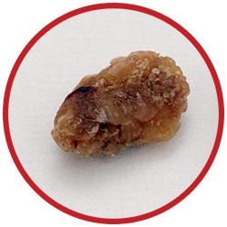 kidney stone pain images kidney stone pain pictures