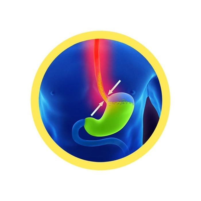 Acid Reflux real image
