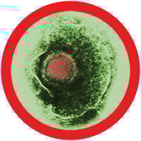Cold Sore Herpes Simplex Virus 1